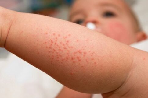 Alergia u dieťaťa ako príznak prítomnosti červov